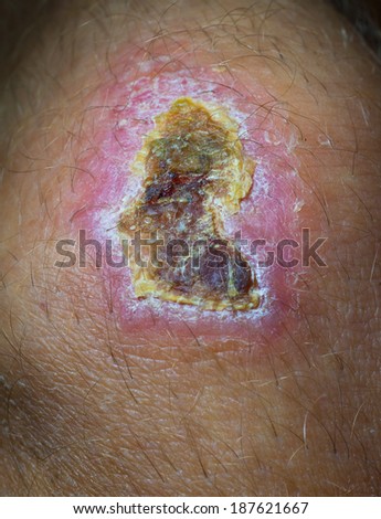 Dried wound on the knee