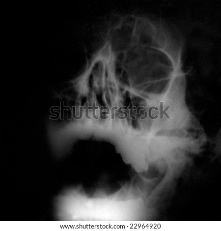 Skull xray image for medical diagnosis