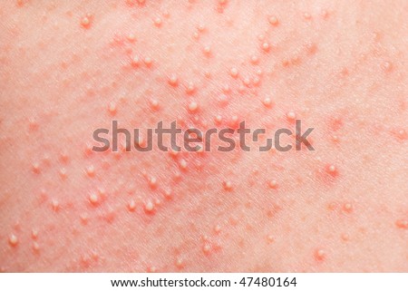allergic reaction rash. stock photo : allergic rash on