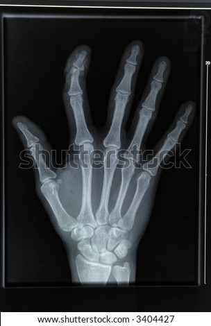 an xray of a hand with broken finger