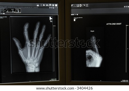 an xray shows a broken finger
