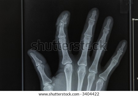 a hand with a broken finger on x-ray