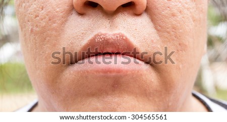 Woman with oily skin and acne scars