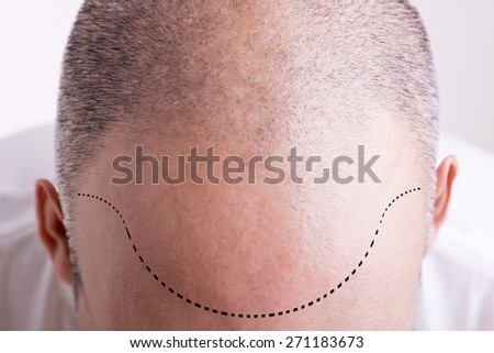 Top view of a men\'s head with a receding hair line