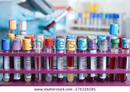 rack of blood tubes with barcode labels for proper identification and background hand of laboratory technician holding a blood tube for scan / Tray with tubes with blood samples labeled