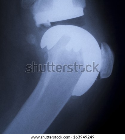 Female Knee, plastic prosthesis