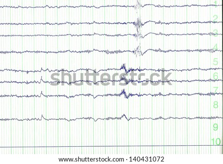 pulse trace of oscilloscope for a electro-encephalogramme (EEG) for search epilepsie