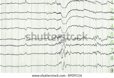 pulse trace of oscilloscope for a electro-encephalogramme (EEG) for search epilepsie