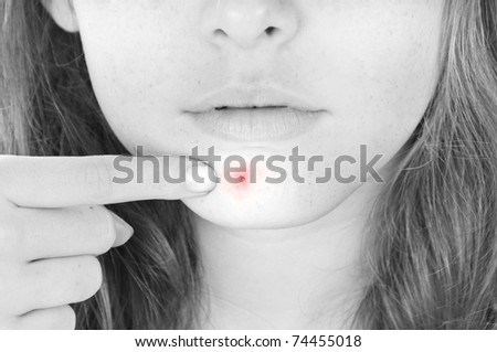 Teenage girl with painful pimple