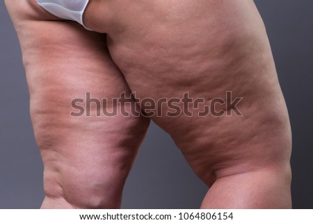 Fat female body with cellulite, overweight hips and legs on gray background