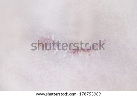 Pain and scars on human skin. Traces of sutures