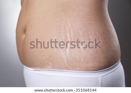 Female belly with pregnancy stretch marks closeup on a gray background