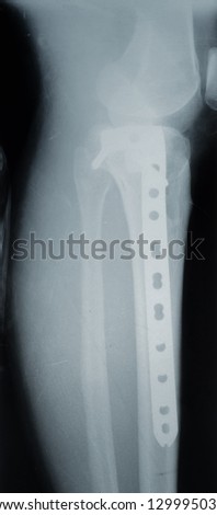 screws and plates to connect the fracture of the tibia, X-ray