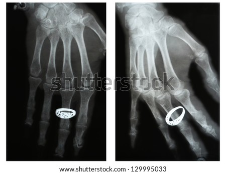 dislocated finger, two projections,  X-ray. ring on the finger