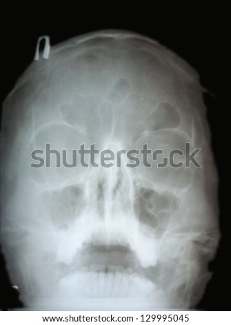 broken nose, X-ray