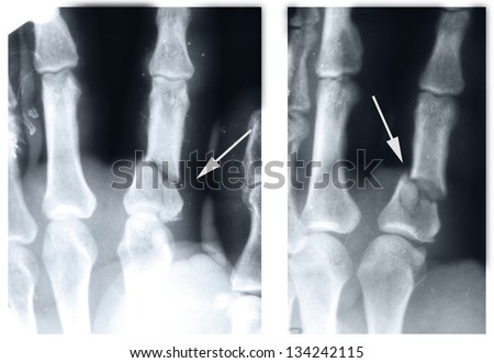 phalanx of the index finger fracture (boxer fracture), X-ray