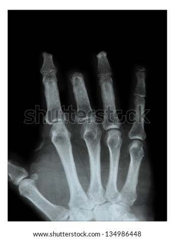phalanx of the middle finger amputated hand, X-rays in two profiles