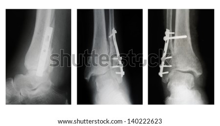 fracture of the lower part of the fibula, view of three positions, X-ray