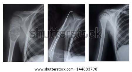 the upper part of the humerus, three stages of the disease, X-ray