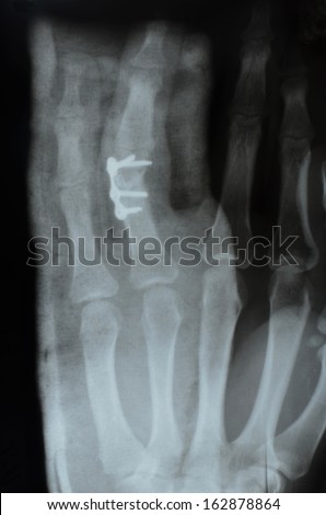 phalanx of the index finger fracture(boxer fracture), metal staple,  X-ray