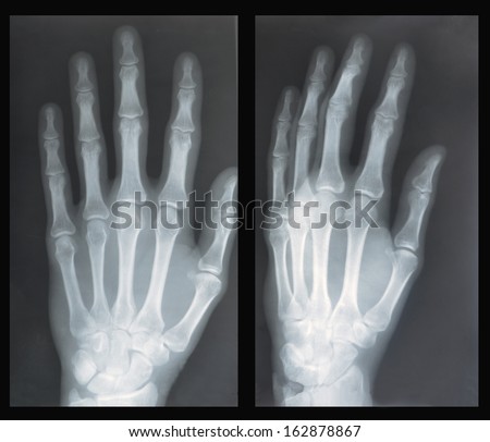 Hand in two projections, X-ray