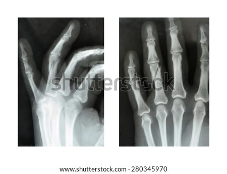 X-rayfractured ring finger hands