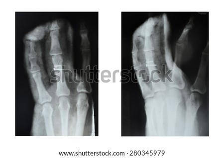 X-rayfractured ring finger hands, fractured ring finger hands