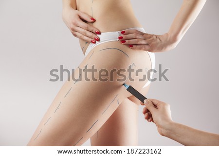 Female body with the drawing arrows on it isolated on white. Fat lose, liposuction and cellulite removal concept