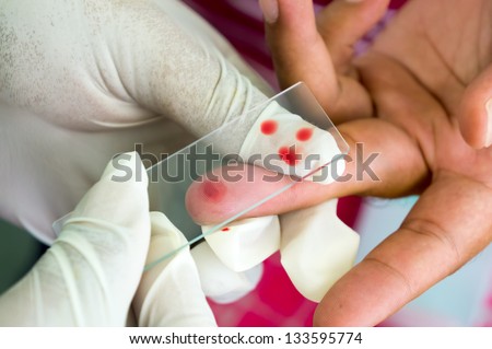 Taken blood films for Malaria parasite on fingers