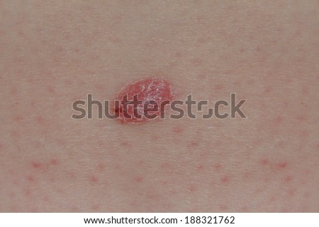 Psoriasis is a Common Skin Condition that Causes Raised Patches of Inflamed Skin