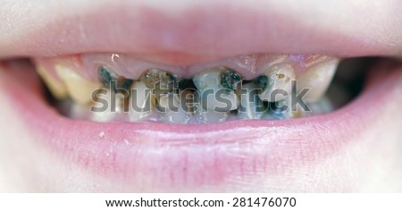 cavities on the teeth of the child