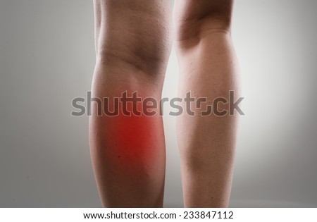 Injured female legs with red spots. Muscle strain and stretch treatment concept.