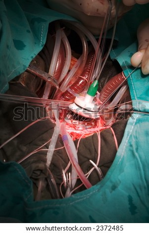 prosthetic heart valve implatation