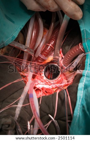 prosthetic heart valve implahtation
