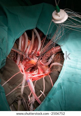 prosthetic heart valve implantation