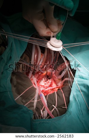prosthetic heart valve implantation in operation room