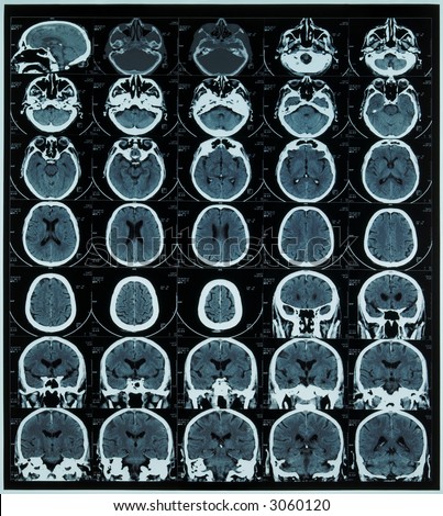 magnetic resonance scan of brain and cranium