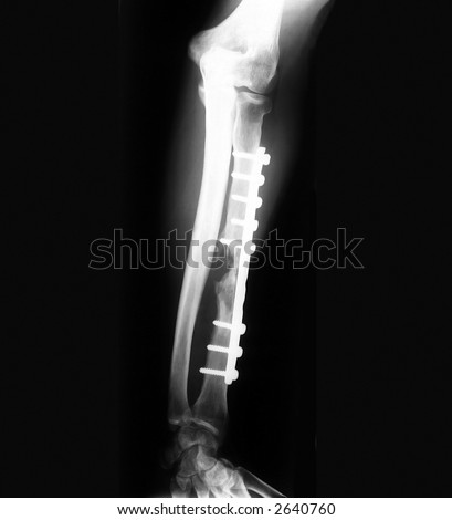 Broken forearm with implant on x-ray film