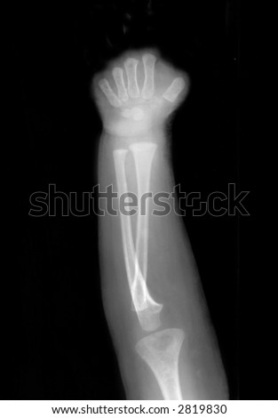 X Ray Broken