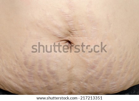 Close up stretch marks on Asian woman belly