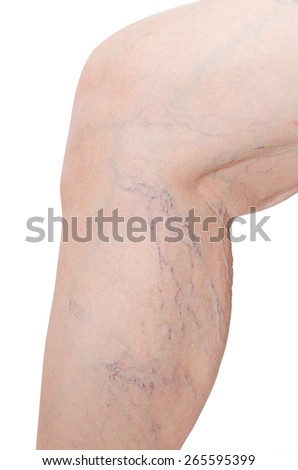 Close up woman legs with varicose veins on white background