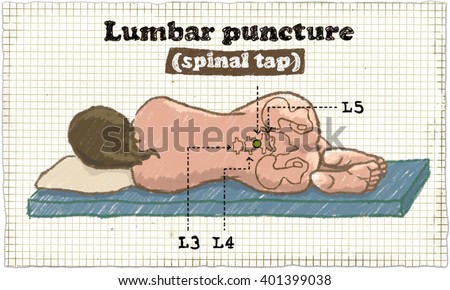 Spinal Puncture Illustration