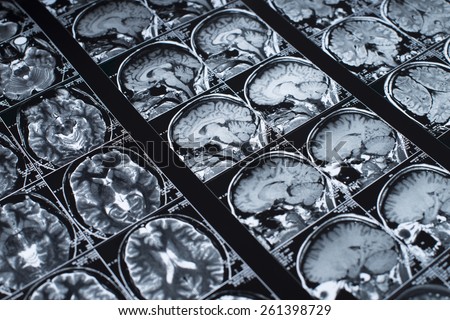 MRI Brain Scan of head and skull