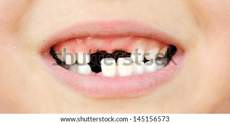 little girl and broken teeth