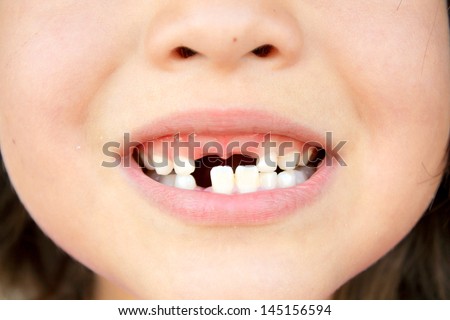 little girl and broken teeth