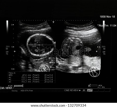 Ultrasound scans during pregnancy in the twenty week