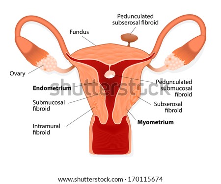 Uterine fibroids are benign tumors. They are denser than normal myometrium.  Tumor appear as round solid nodules. Other common names uterine fibroids, leiomyoma, myoma, fibromyoma, fibroleiomyoma.