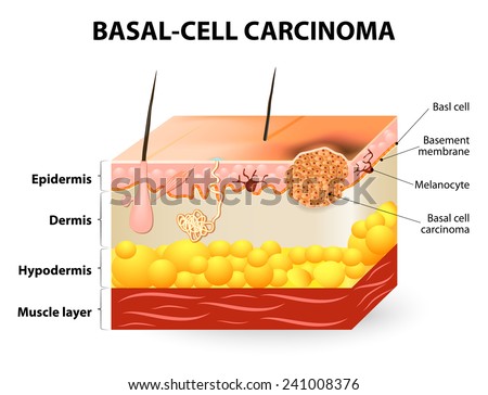 skin cancer. Basal-cell carcinoma or basal cell cancer (BCC). Schematic representation of skin. Melanocytes are also present and serve as the source cell for melanoma.