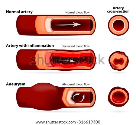 Normal artery, inflamed or narrowed artery and artery with an aneurysm. cross-section