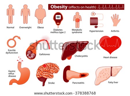 Obesity and overweight infographic. Effects on health.  Medical infographic. Set elements and symbols for your design.